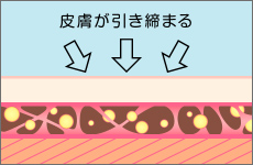 脂肪吸引のイメージ04